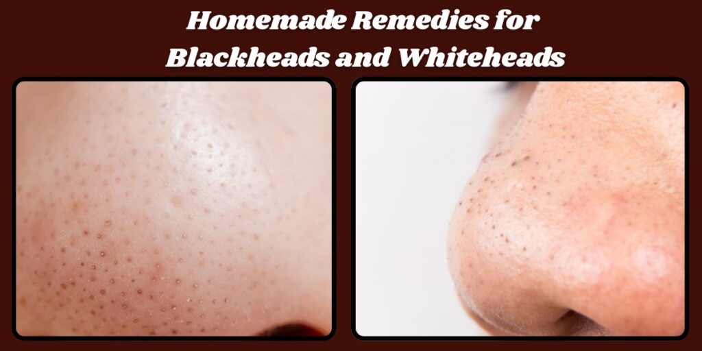 Blackheads and Whiteheads1