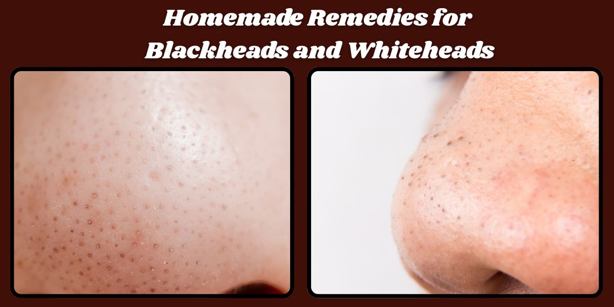 Homemade Remedies for Blackheads and Whiteheads