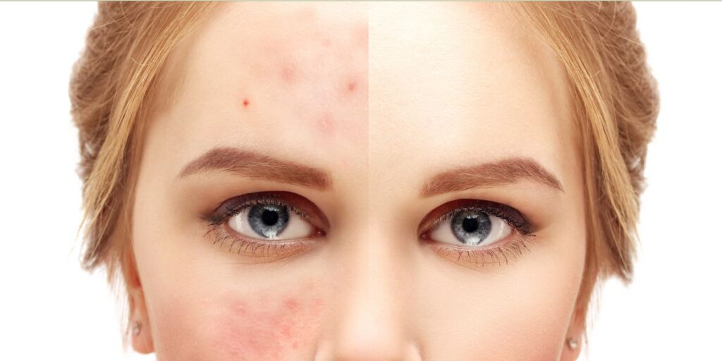 carrot seeds oil Helps with Acne and Infections