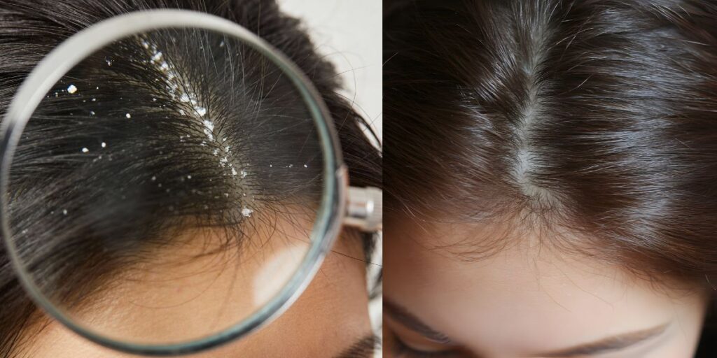 Reduces Dandruff and Dry Scalp