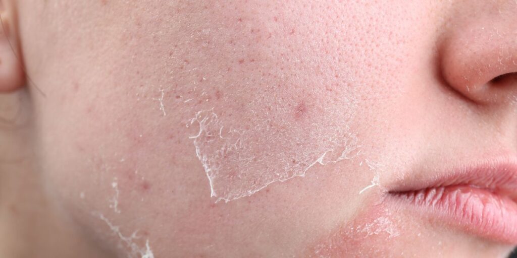 Side Effects of Turmeric and Honey on Face