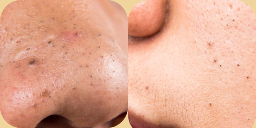 Before and After Using Salicylic Acid