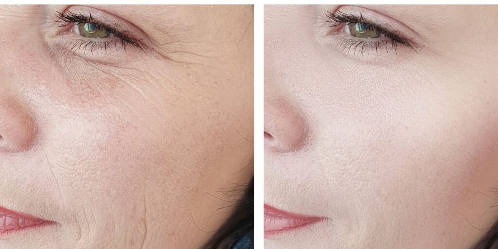 fine line remove at home